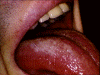 hairy tongue.gif (58131 bytes)
