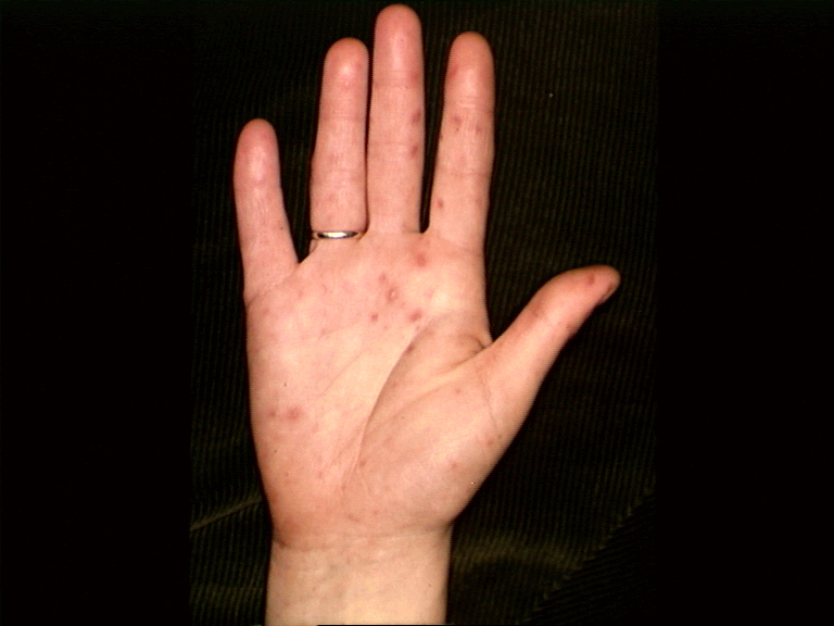 hand foot and mouth disease in adults pictures