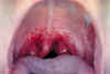 strep-thr.jpg (34736 bytes)