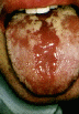 candida.gif (34953 bytes)