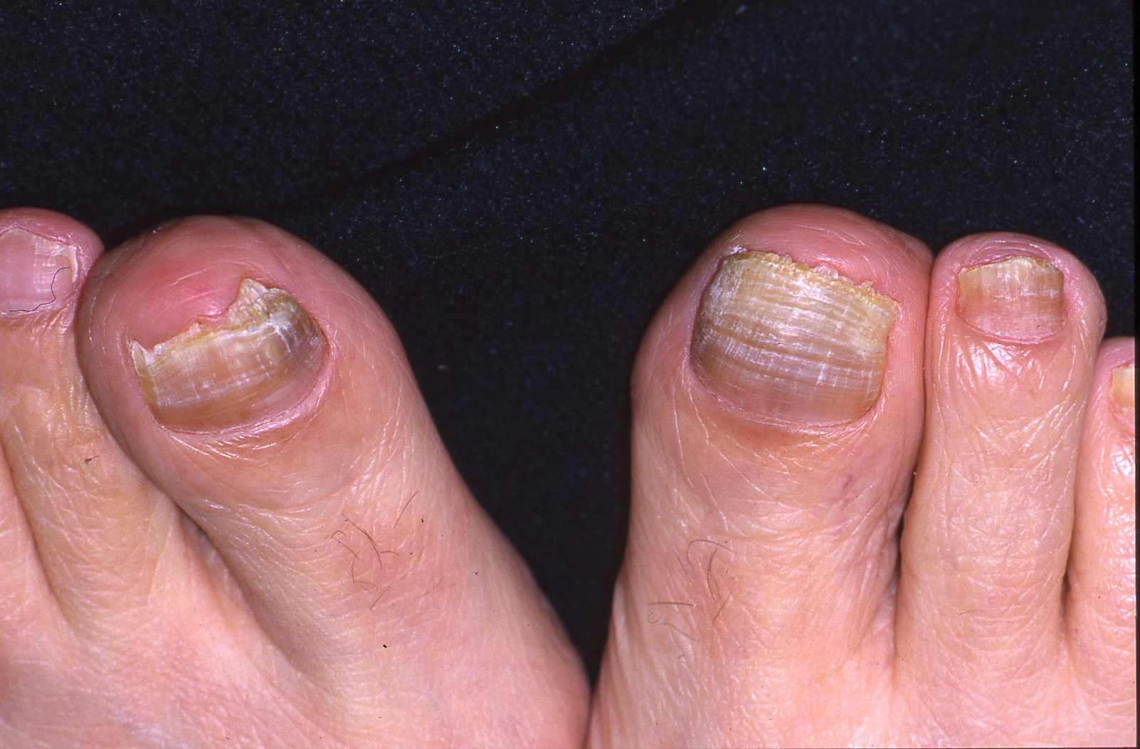 Applied Sciences | Free Full-Text | A New In Vitro Model to Evaluate  Anti-Adhesive Effect against Fungal Nail Infections