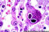 Cytomegalovirus1.jpg (59683 bytes)